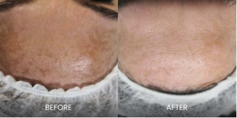 Hyperpigmentation Nanopeel